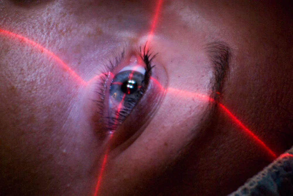 Laser Eye Surgery